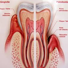 parodontite